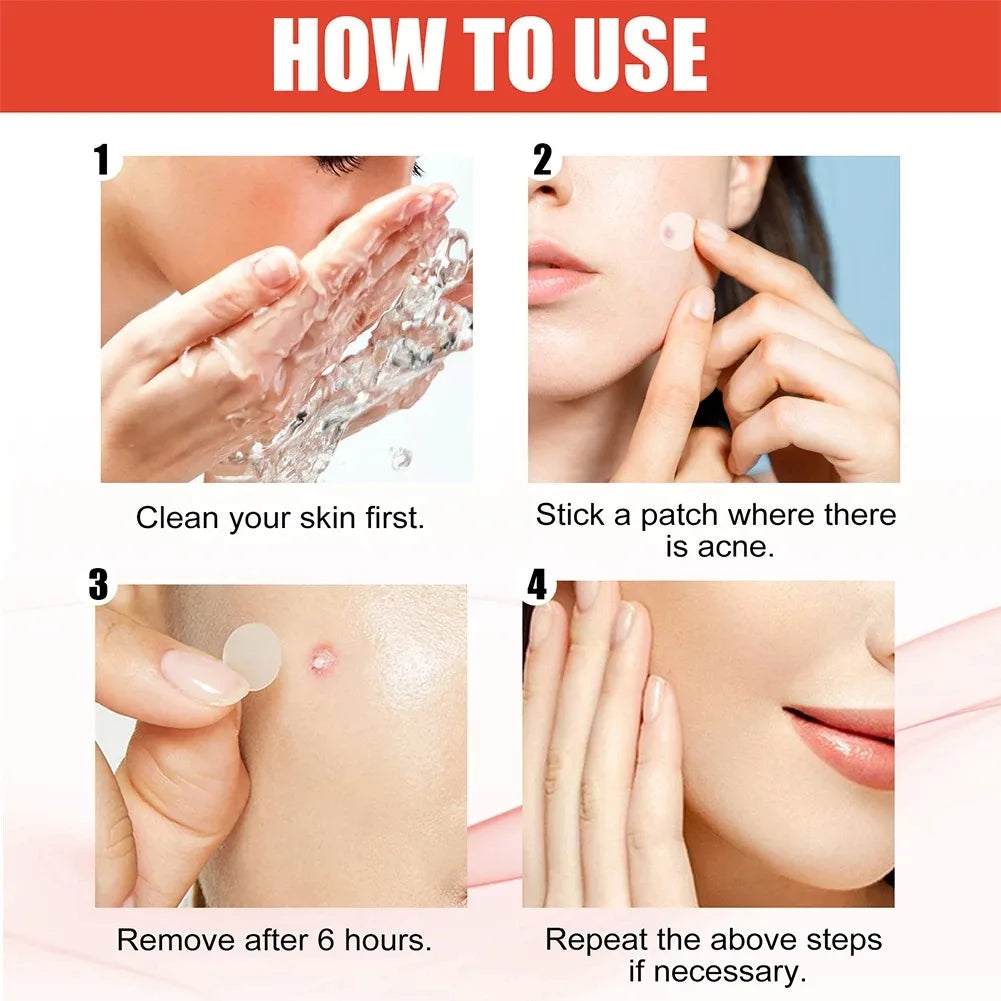 Pimple Patch Antiacne 240 un – Adesivos Hidrocoloides com Centella Asiática