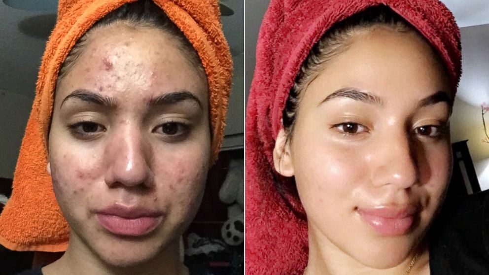 Gel Secativo Antiacne com 2% Ácido Salicílico, Niacinamida e Vitamina E – Miss Lary Skin 10ml