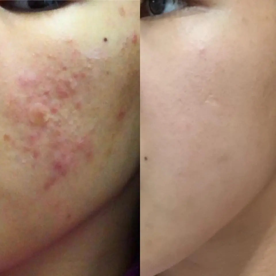 Gel Secativo Antiacne com 2% Ácido Salicílico, Niacinamida e Vitamina E – Miss Lary Skin 10ml